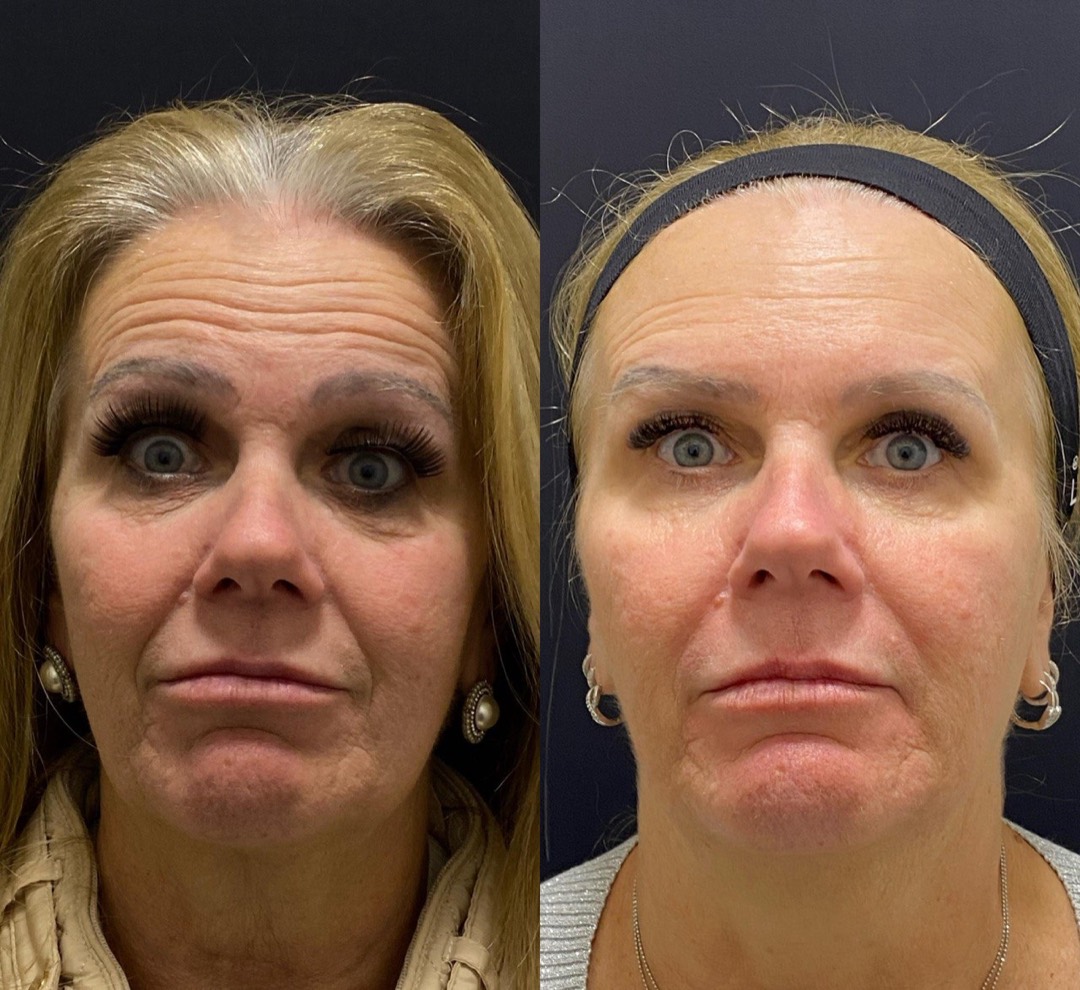 Antes e depois — Clínica Fischer