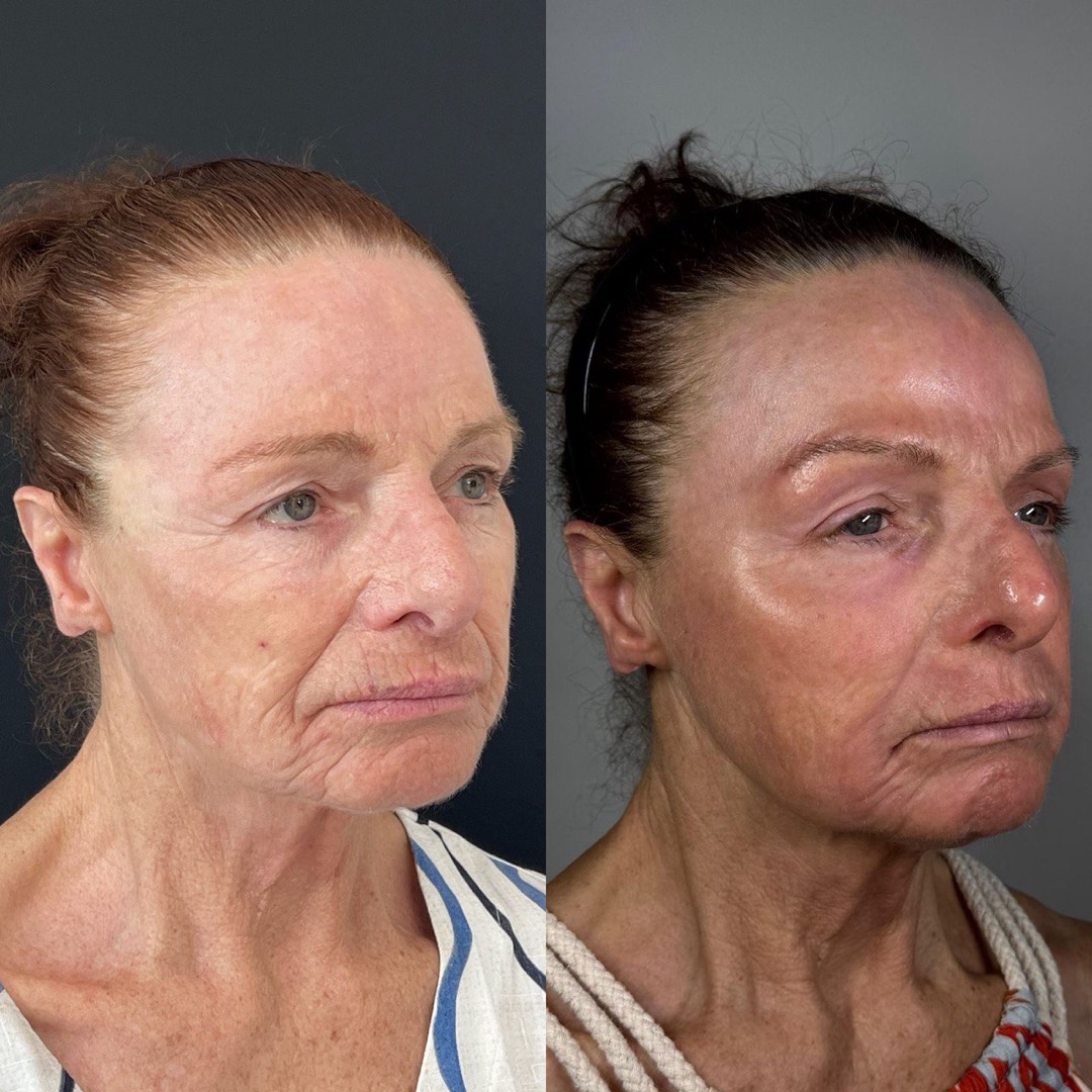 Antes e depois — Clínica Fischer