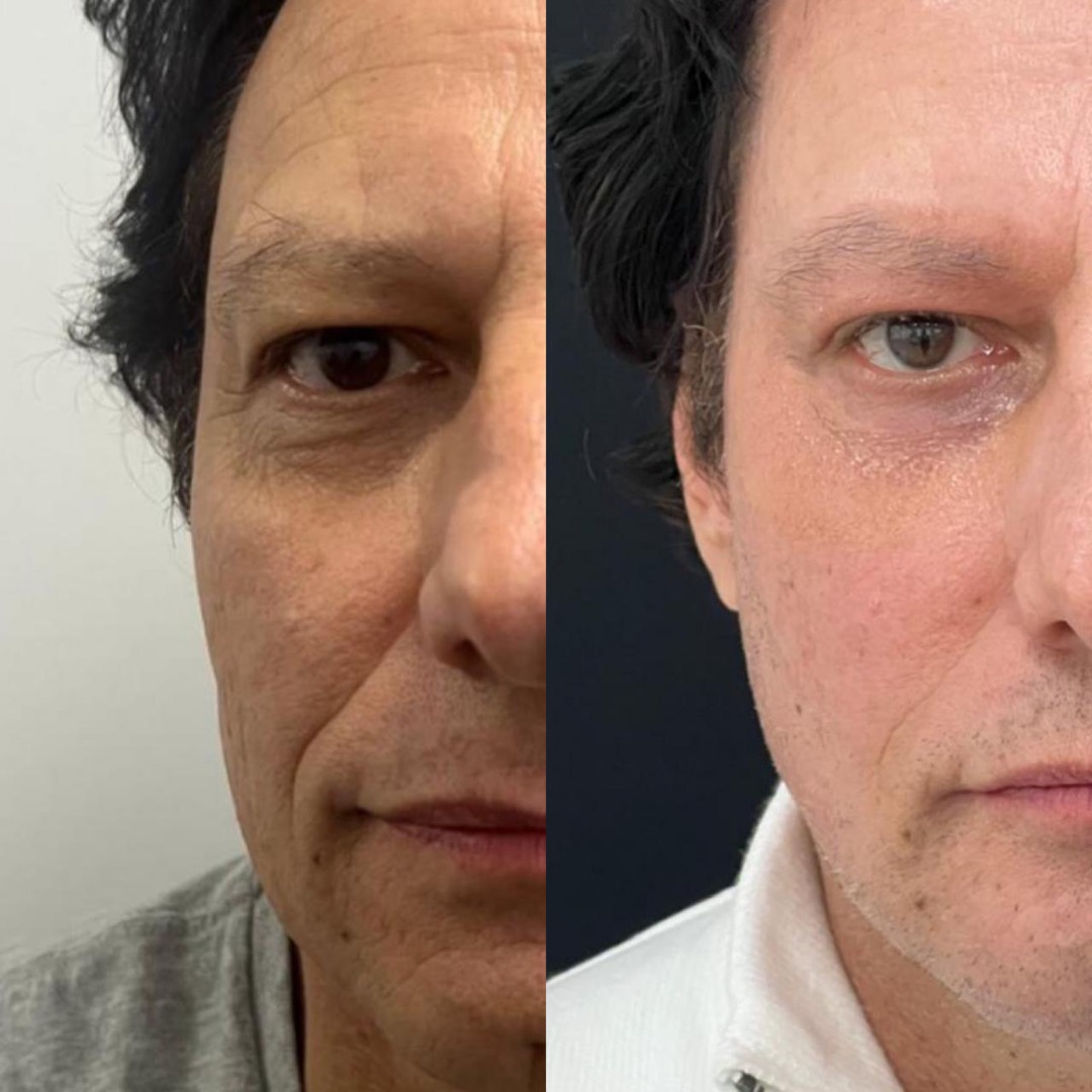 Antes e depois — Clínica Fischer