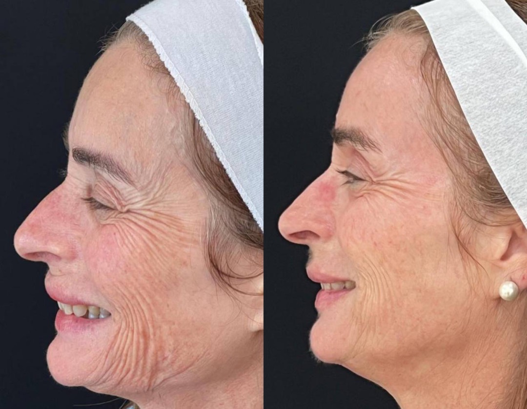 Antes e depois — Clínica Fischer