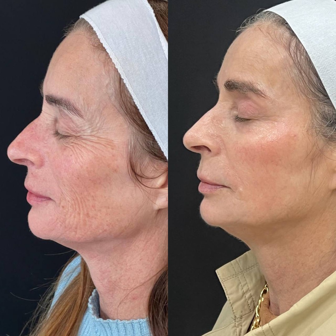 Antes e depois — Clínica Fischer